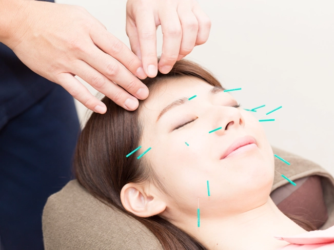 美容鍼